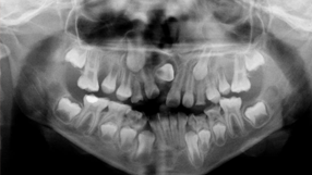 dienteretenido