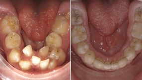 microsomias coped ortodoncia