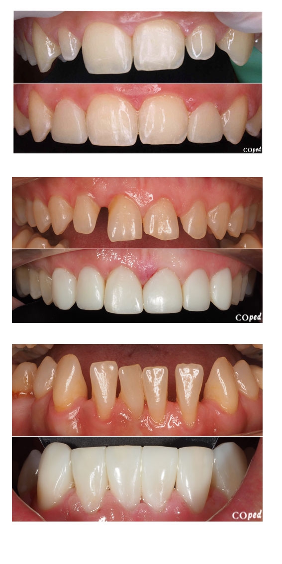 xth fd0b9a1c7f8985b1ea08ff5f1094917c carillas esteticas coped2343.jpg.pagespeed.ic .4VrMUbZl6 