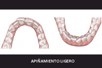 APINAMIENTO LIGEROn