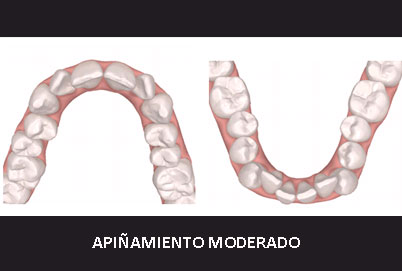 APINAMIENTO MODERADOn