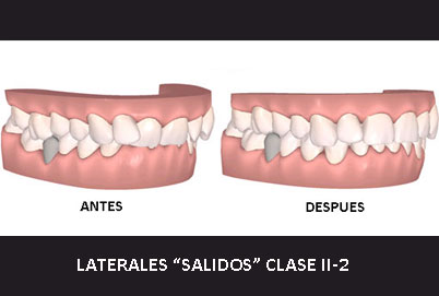 LATERALES SALIDOSn