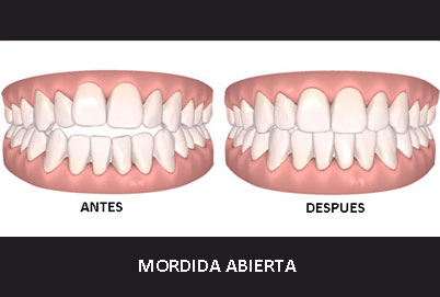 MORDIDA ABIERTAn