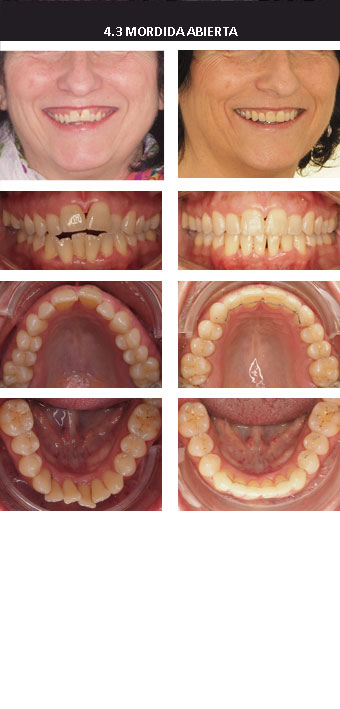 Plantilla ejemplo casos invisalign