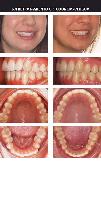 6. Retratamiento de ortodoncia antigua | Invisalign Mallorca |