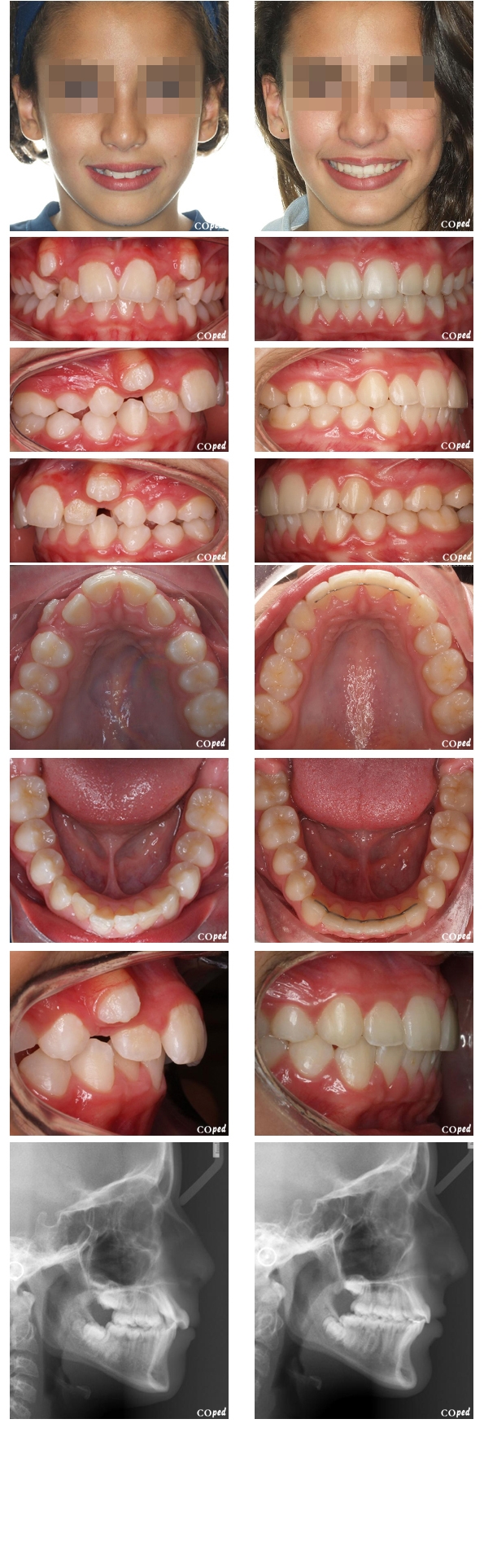 caso adol 40b