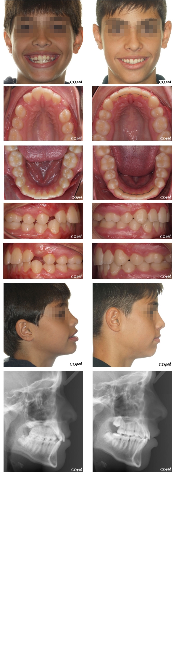 caso adol 45b