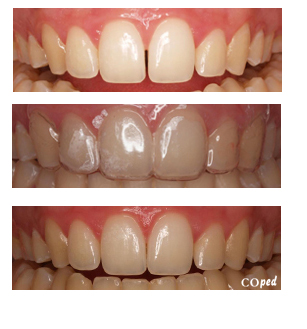 Se me han movido los dientes