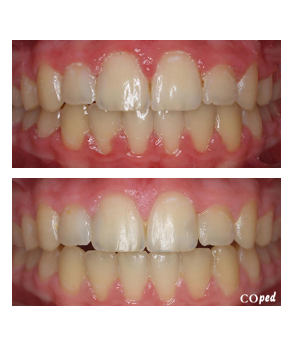 Dientes movidos por la lengua