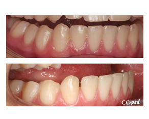 Diastema abajo