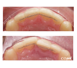 Se han “montado” los dientes