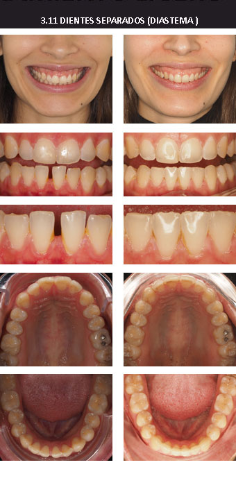 3.11 DIASTEMA flo
